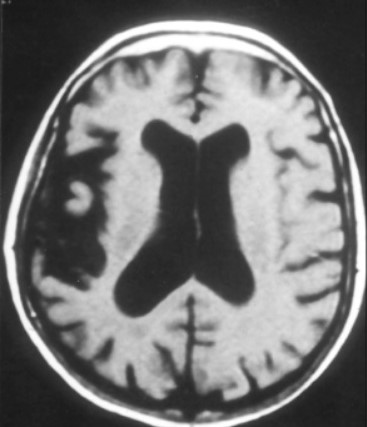 "My Hand Wants to Kill Me!' - What's Your Diagnosis for This Patient?